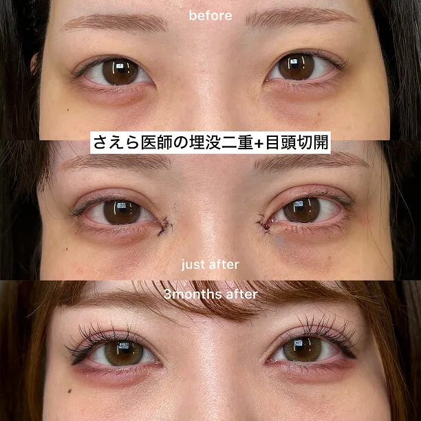 埋没二重術