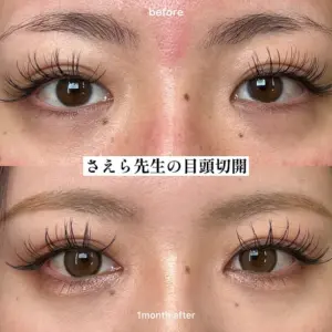 目頭切開
