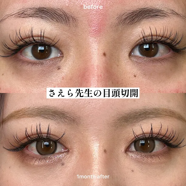 目頭切開