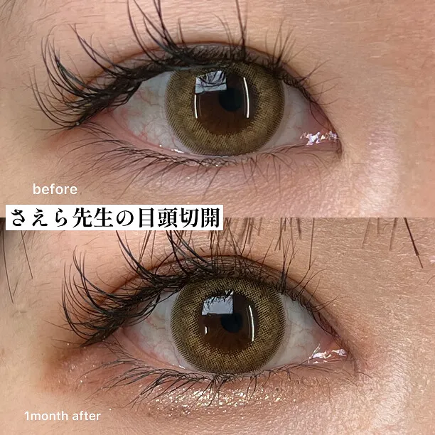 目頭切開