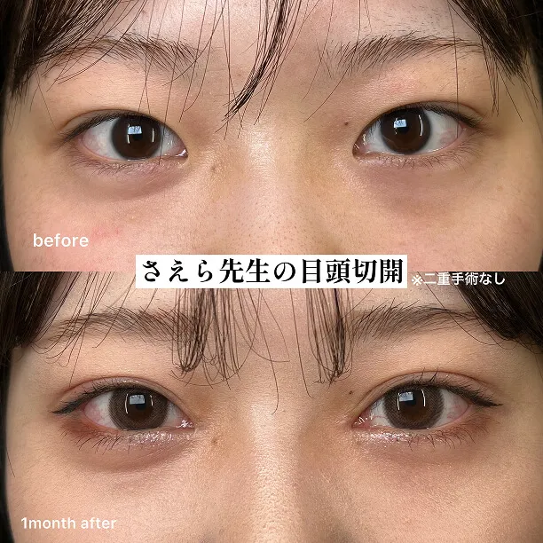 目頭切開