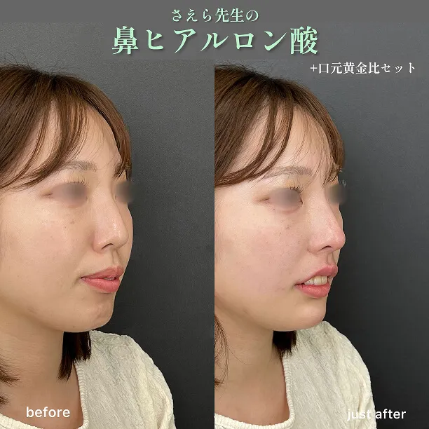 ヒアルロン酸