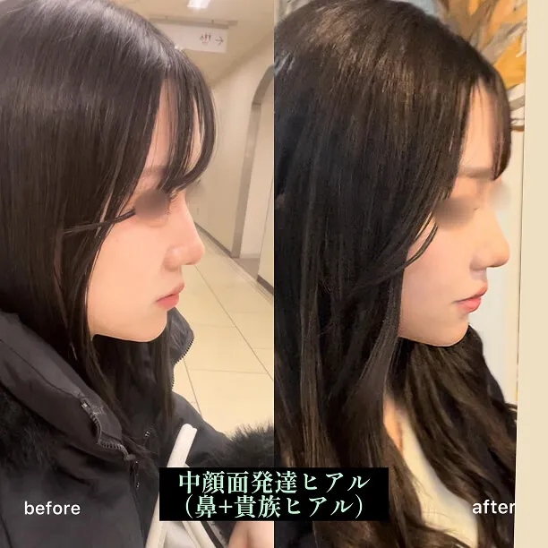 ヒアルロン酸