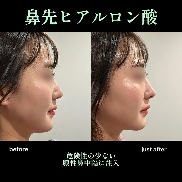 ヒアルロン酸