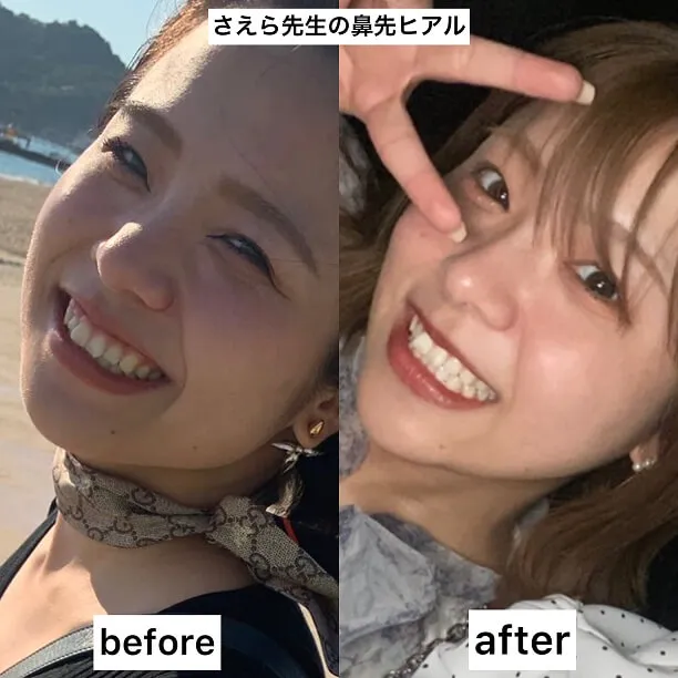 ヒアルロン酸