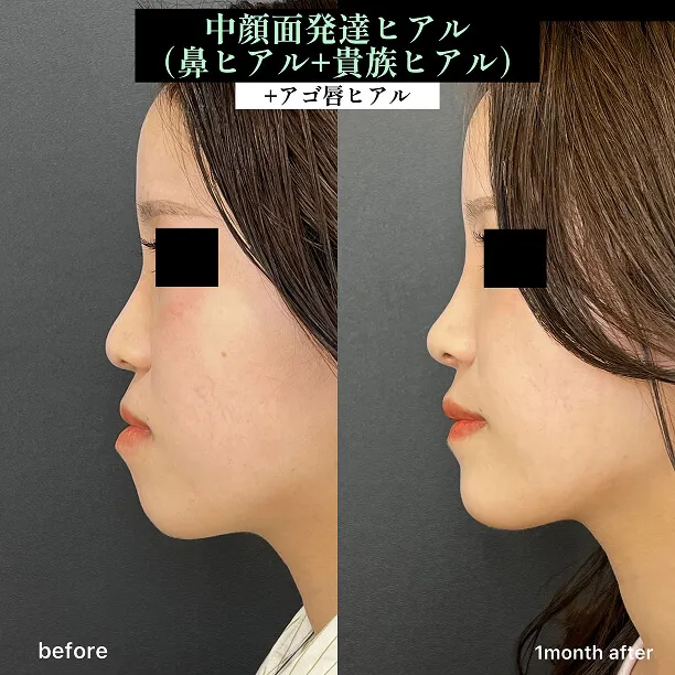 ヒアルロン酸