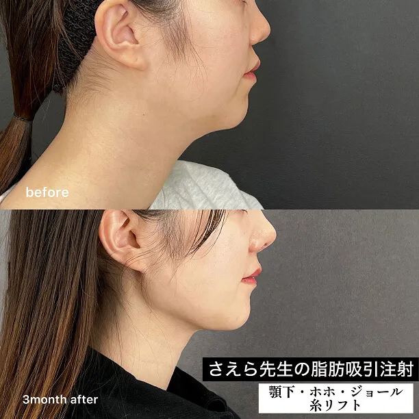 糸リフト