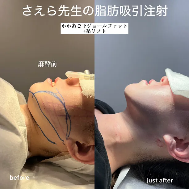 糸リフト