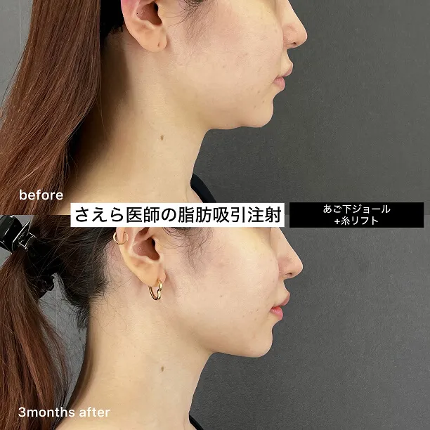糸リフト